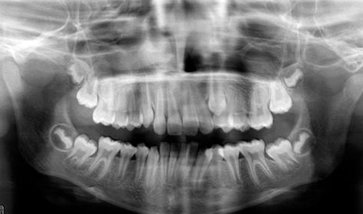 Radiografías indiscriminadas
